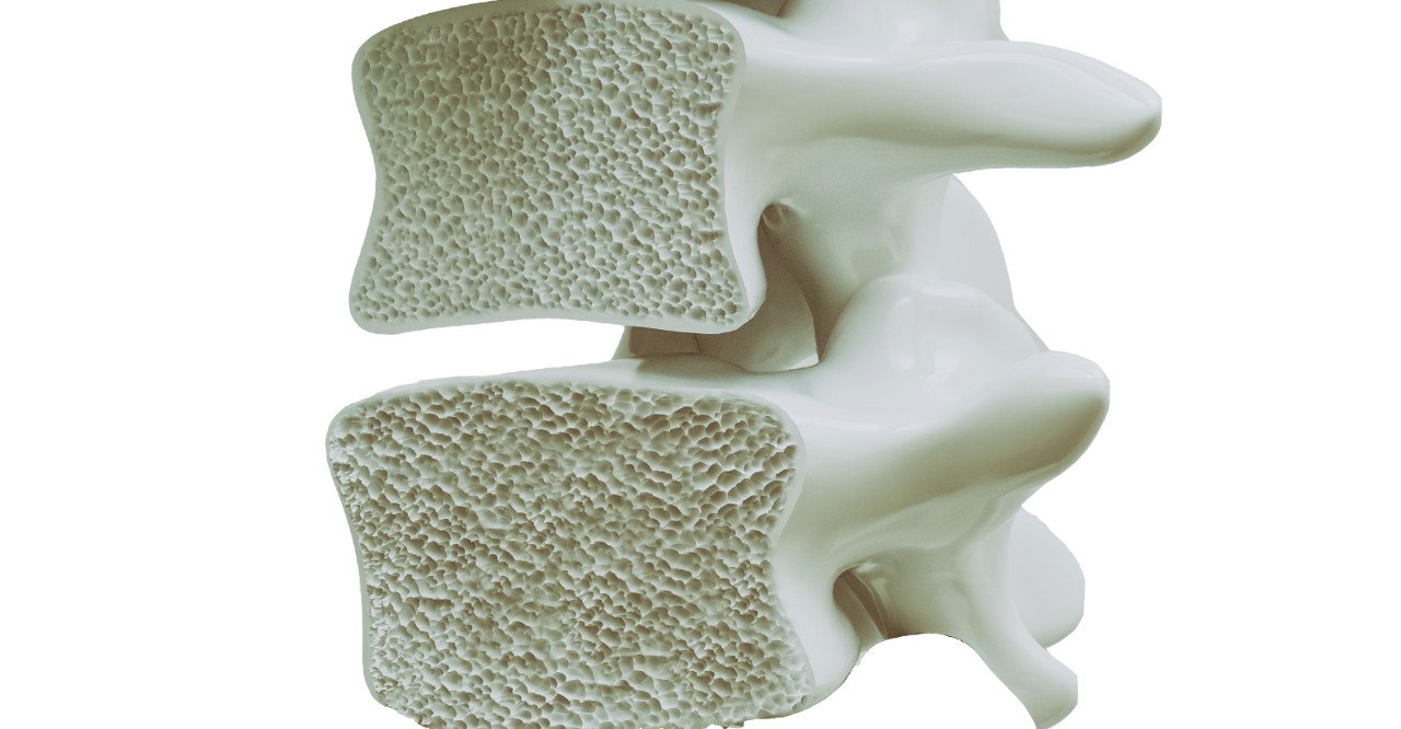 Переломы позвоночника на фоне остеопороза thumbnail