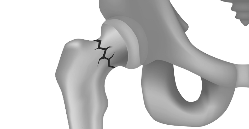 Перелом шейки бедра