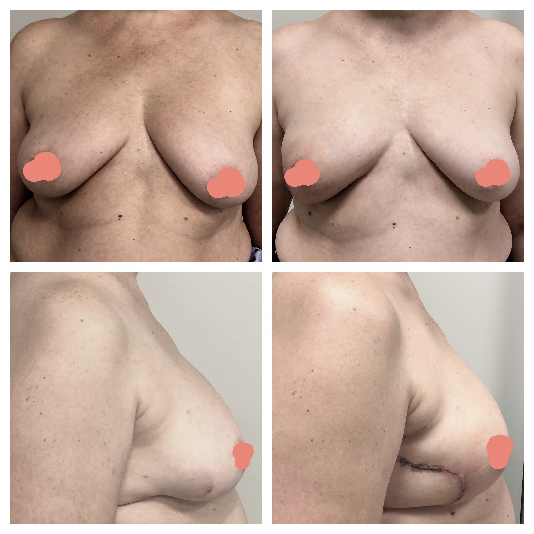выделения из груди при надавливании у женщин фото 33