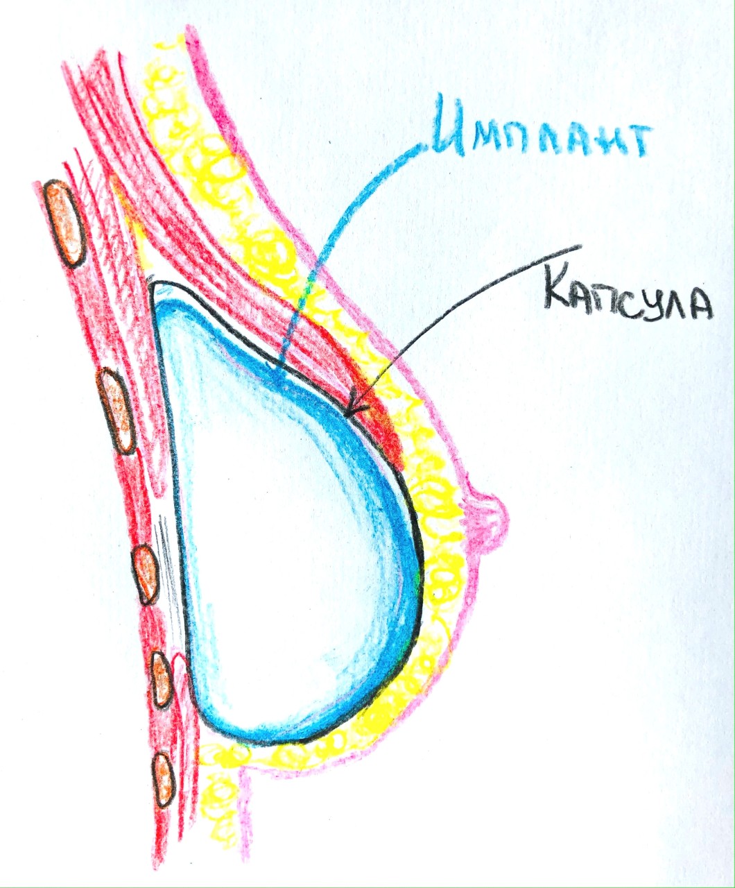 Имплант Молочной Железы Фото
